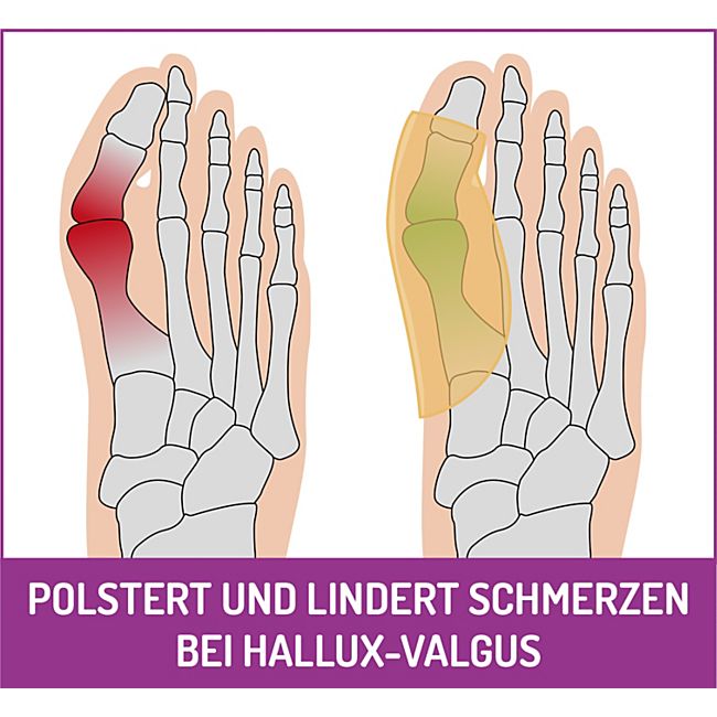 babybutt FußGut Hallux Überbeinschutz 1 Paar Clearance-Verkauf